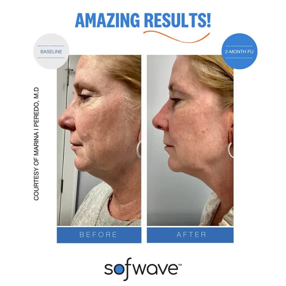 Sofwave: Face, Neck & Brow (2 Sessions)